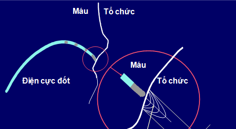 Cắt đốt qua cathter các rối loạn nhịp thất tồn tại trong hội chứng vành cấp