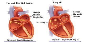 Trị liệu kháng loạn nhịp ở bệnh nhân rối loạn nhịp thất tồn tại và hội chứng vành cấp
