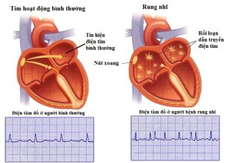 Trị liệu kháng loạn nhịp ở bệnh nhân rối loạn nhịp thất tồn tại và hội chứng vành cấp