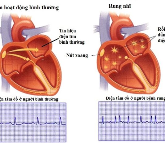 Trị liệu kháng loạn nhịp ở bệnh nhân rối loạn nhịp thất tồn tại và hội chứng vành cấp